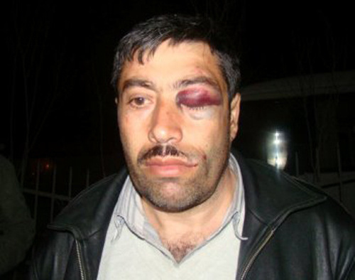Tazakhan Miralamli after beating at the Yasamal District Police Division. Azerbaijan. Courtesy of the "Azadlyg" (Freedom) newspaper Tazakhan Miralamli after beating at the Yasamal District Police Division. Azerbaijan. Courtesy of the "Azadlyg" (Freedom) newspaper