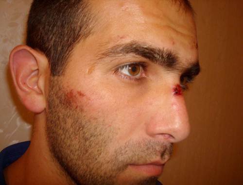 Malik Appaev with traces of beatings on his face, after release from the Elbrus ROVD (District Interior Division). Photo from the website of the Human Rights Centre "Memorial" (www.memo.ru) Malik Appaev with traces of beatings on his face, after release from the Elbrus ROVD (District Interior Division). Photo from the website of the Human Rights Centre "Memorial" (www.memo.ru)