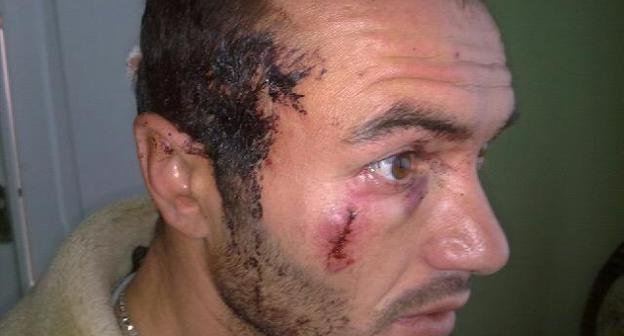 Dmitry Sobaev, a supporter of Alla Djioeva, who was beaten by unidentified persons on his way to Tskhinvali. Photo: uasamonga.ru Dmitry Sobaev, a supporter of Alla Djioeva, who was beaten by unidentified persons on his way to Tskhinvali. Photo: uasamonga.ru