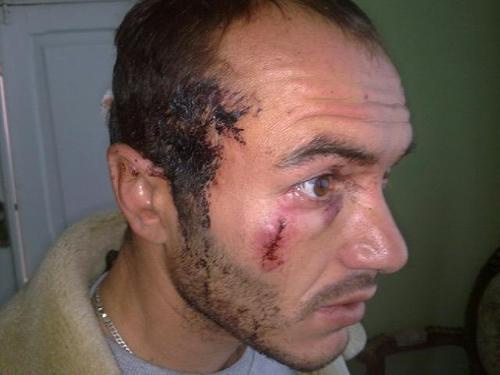 Dmitry Sobaev, a supporter of Alla Djioeva, who was beaten by unidentified persons on his way to Tskhinvali. Photo: uasamonga.ru Dmitry Sobaev, a supporter of Alla Djioeva, who was beaten by unidentified persons on his way to Tskhinvali. Photo: uasamonga.ru