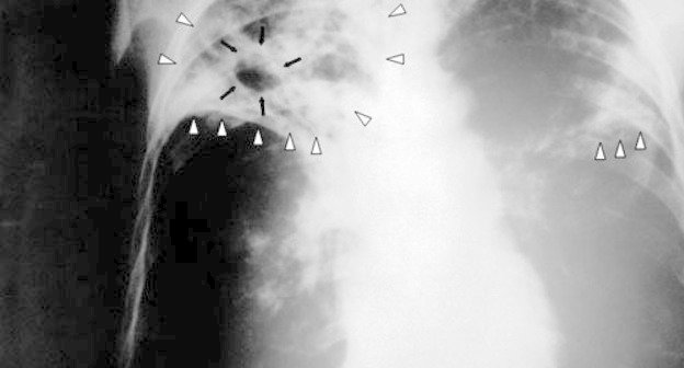 X-ray image of TB patient. Photo by http://ru.wikipedia.org X-ray image of TB patient. Photo by http://ru.wikipedia.org